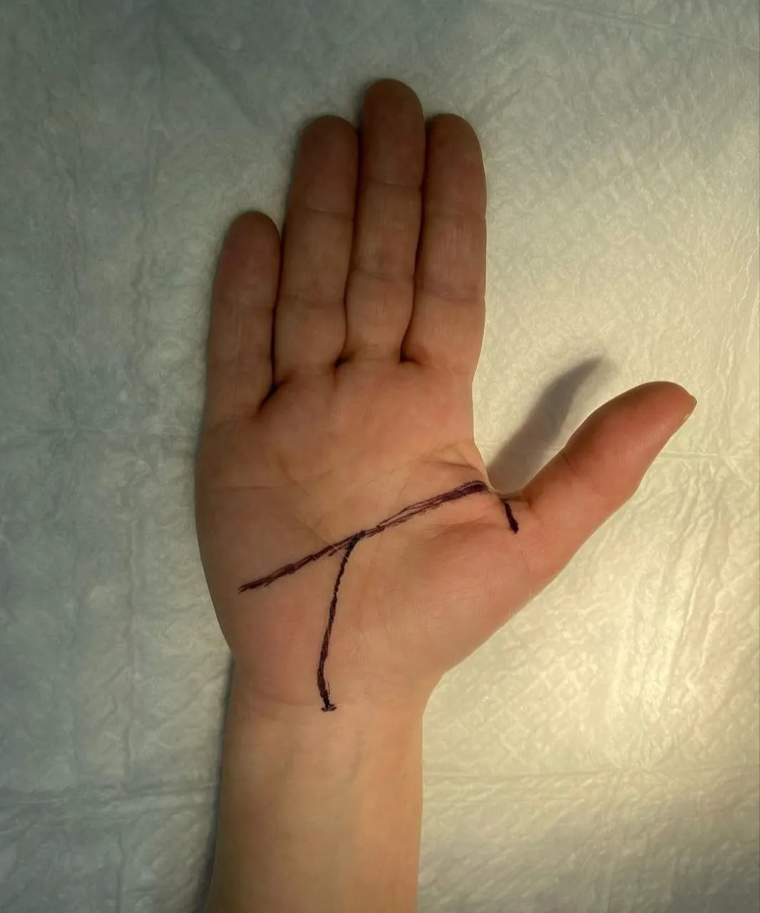 Освобождение локтевого нерва