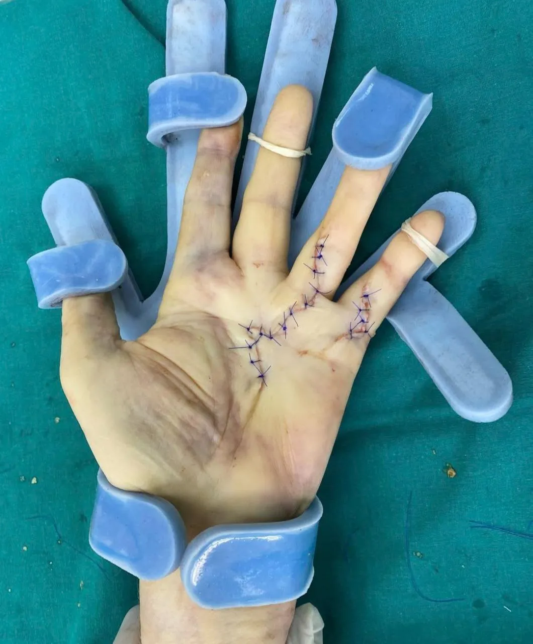 Эндопротезирование суставов