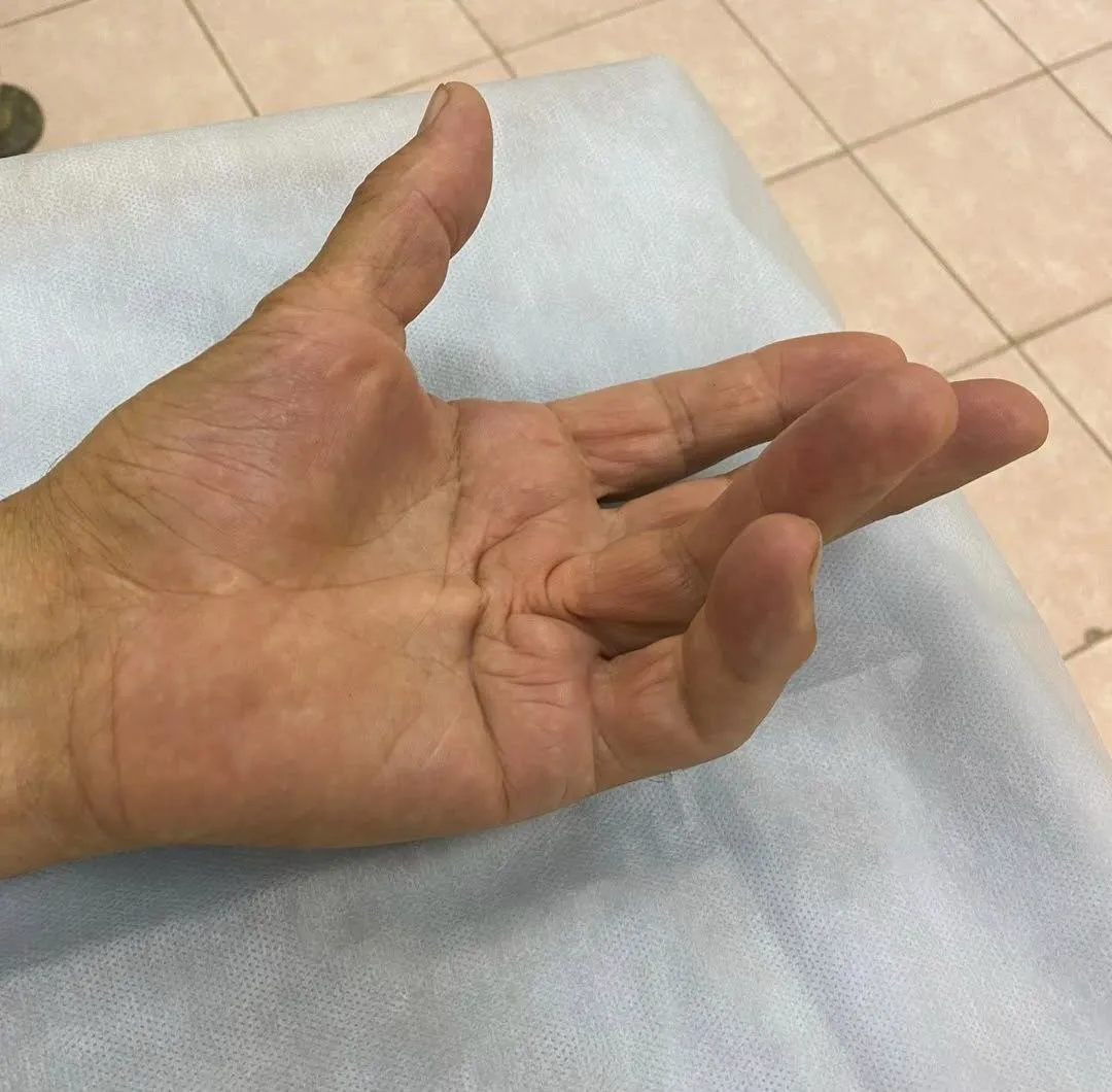 Удаление гигром кисти