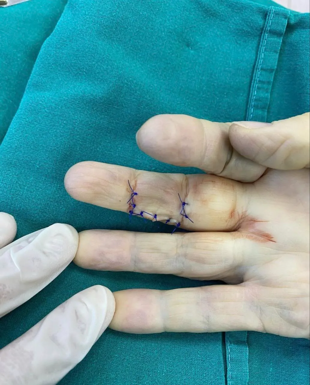 Операции при воспалительных заболеваниях