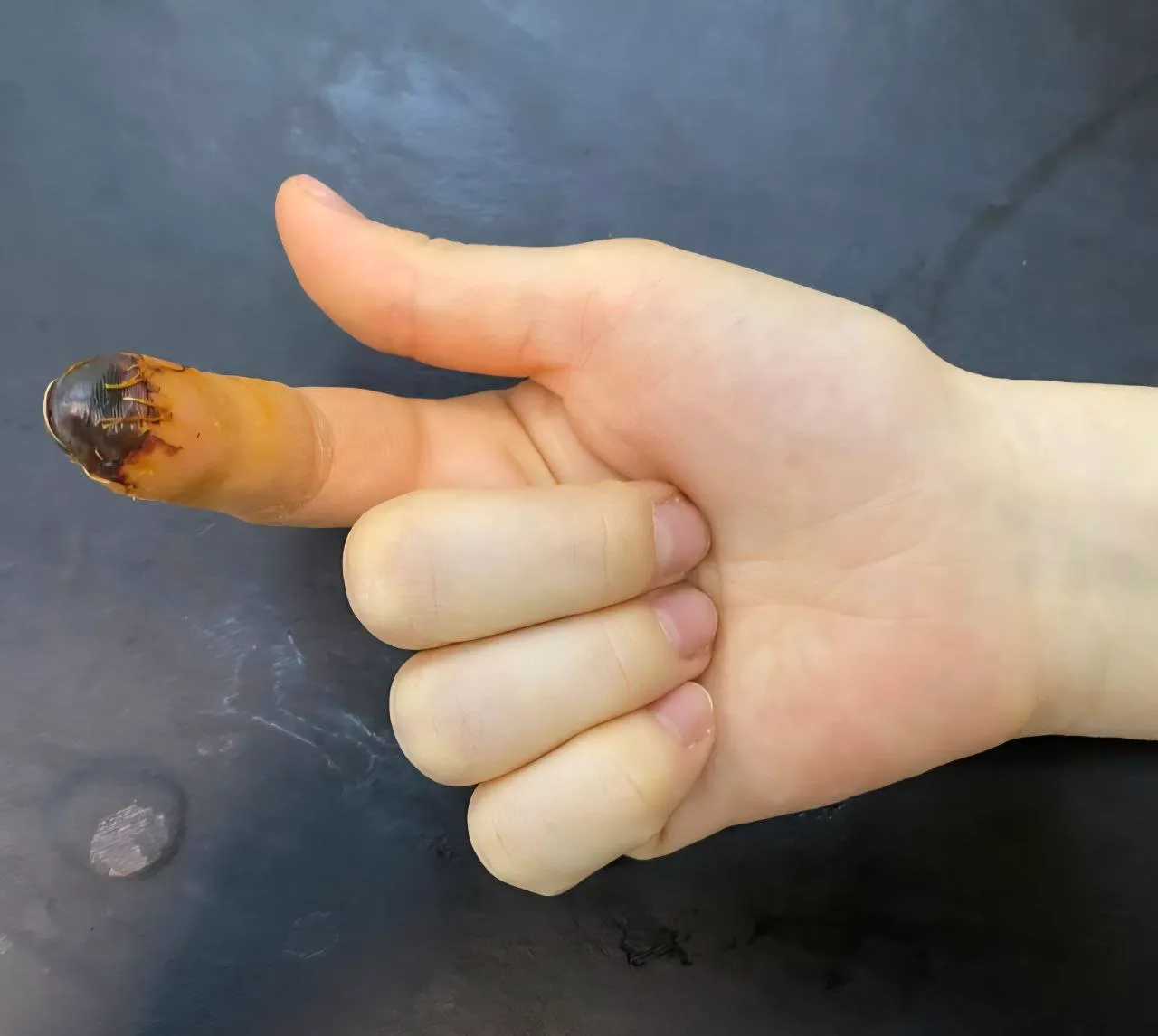 Микрохирургическая реплантация пальцев